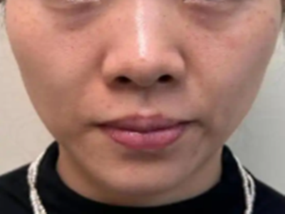 荆州骨性轮廓分层固定抗衰医生！荆州华美邹海东院长，依托面部韧带解剖打造克制自然骨相微调方案