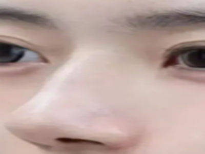 玻尿酸隆鼻多久会消失？玻尿酸隆鼻可以维持多久？