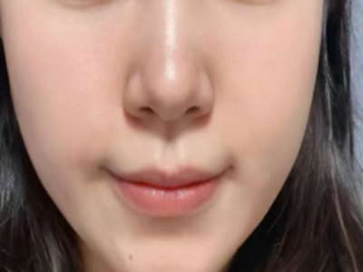 塌鼻子怎么样变挺？垫鼻梁用什么材料好？