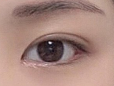 广州做埋线双眼皮多少钱？埋线双眼皮价格贵不贵?