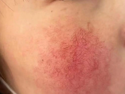 湖北荆州沙敏感肌救星！荆州华美陈慧杰屏障重建阶梯疗法，改善换季泛红刺痛