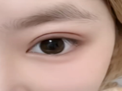 漳州做双眼皮医院哪家靠谱安全？双眼皮手术一般需要多少费用