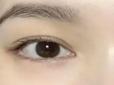 韩式重睑术和传统双眼皮手术有什么区别？